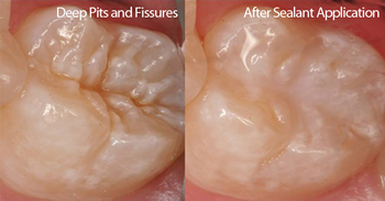 Pit and fissure sealant